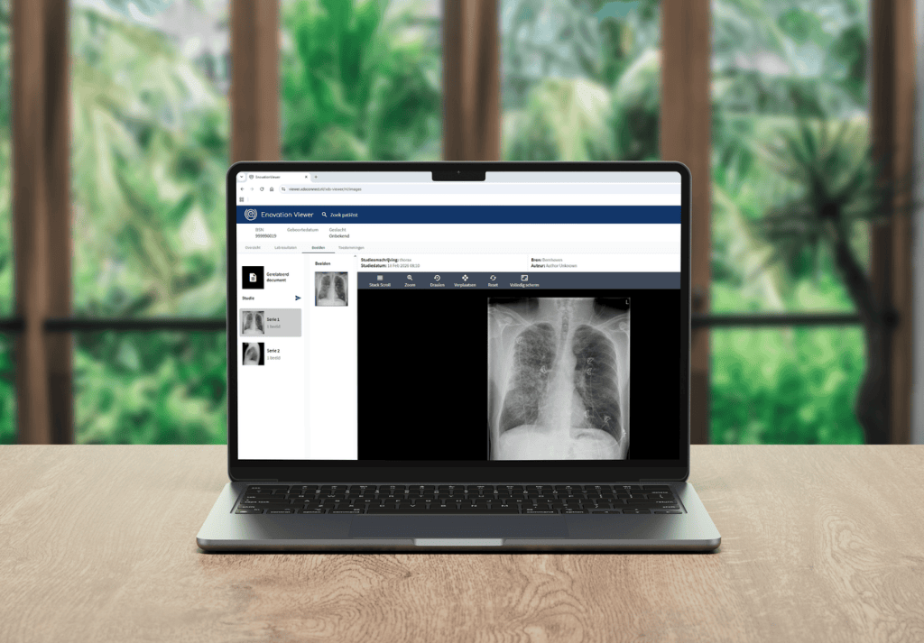 Ein Laptop auf einem Holztisch zeigt einen medizinischen Viewer mit einem Röntgenbild des Brustkorbs.